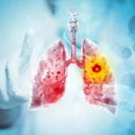 Scientists discover why this deadly lung cancer keeps coming back