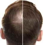 Ancient Chinese medicine could transform hair loss treatment