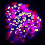 New AI tool predicts cancer spread with surprising accuracy