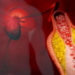 New treatment cuts bad cholesterol by nearly 50% without statins