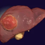 FDA-approved drug may finally help immunotherapy defeat rare liver cancer