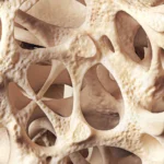 Osteopenia is silently weakening bones in millions of people